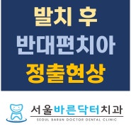 임플란트만 하고싶은데 크라운치료도 같이하라구요? 발치 후 대합치아(맞물리는 치아) 정출현상![월곡역치과 서울바른닥터치과]