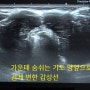 [갑상선은 민병원] 갑상선이 단단한 자갈돌처럼 굳는 병, <리델갑상선염>