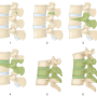 Pedicle subtraction osteotomy, Schwab osteotomy Grade 3 & Grade 4, 척추 절골술