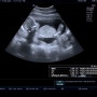 #4 임신일기 16주 17주 18주 19주 성별확인, 2차기형아검사