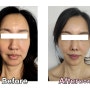 강남 루비성형외과 안면거상술 잘하는 병원 (붓기, 전후 효과, 비용)