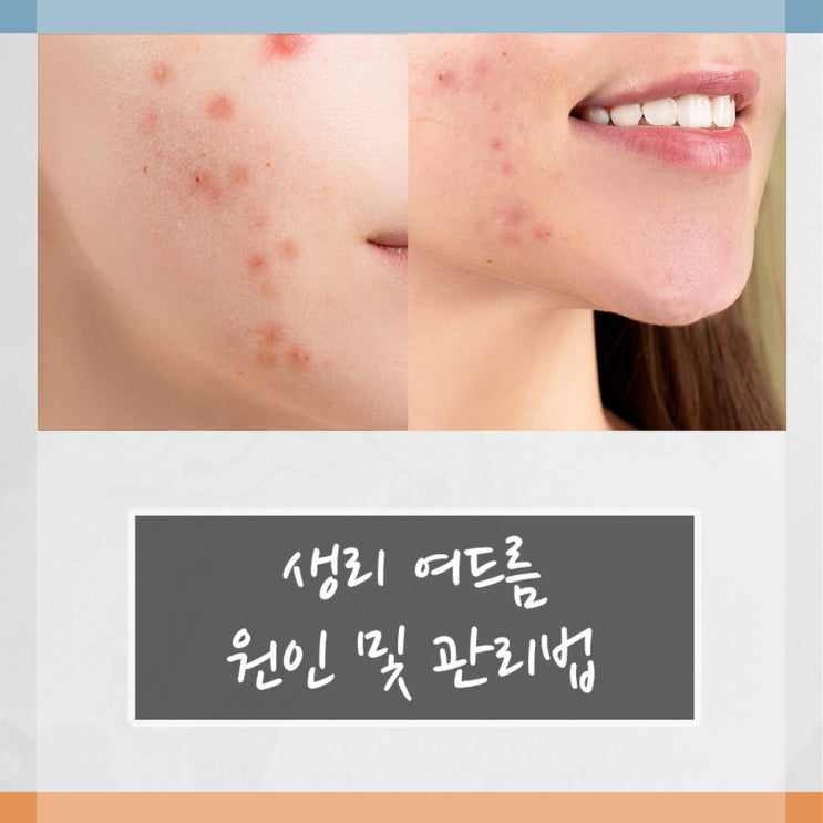 생리 여드름 원인 및 관리법 : 네이버 블로그