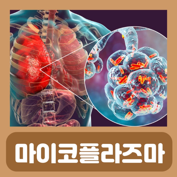 마이코플라즈마 균 폐렴 증상 전염 검사 항생제 약 : 네이버 블로그