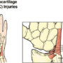 섬유연골纖維軟骨Fibrocartilage이란 손목이 아파요 포항한의원 오천 허한의원