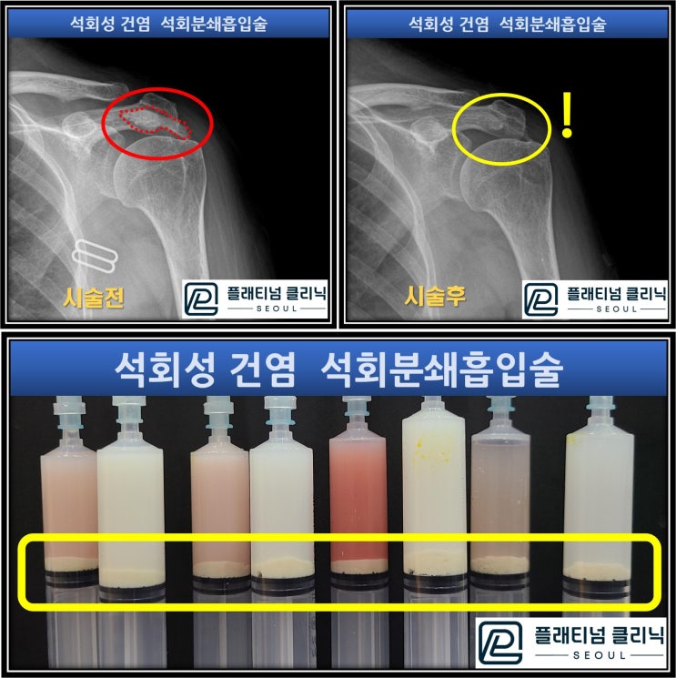 (플래티넘의원) 석회분쇄흡입술은 수술이 아닙니다. 비수술적인 치료법으로 석회성건염을 치료하는 시술입니다.