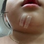 아이 턱 찢어짐 봉합수술 어린이집 사고 아산 박종필성형외과 어린이집 안전공제