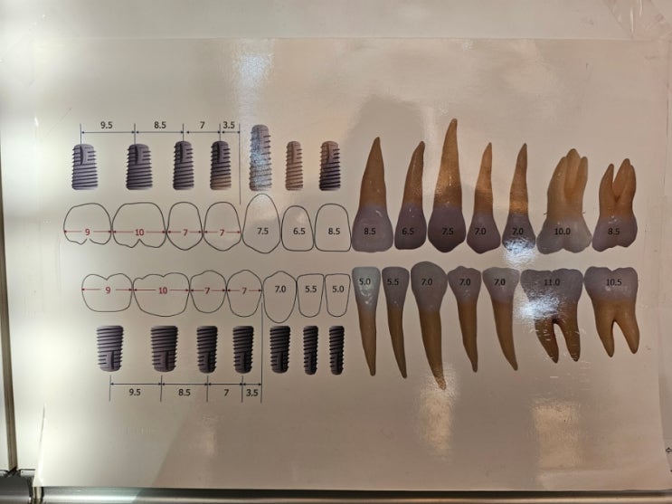 [ITEM] 임플란트 근원심 거리 측정 기구 (implant mesio-distal distance ruler) : 네이버 블로그