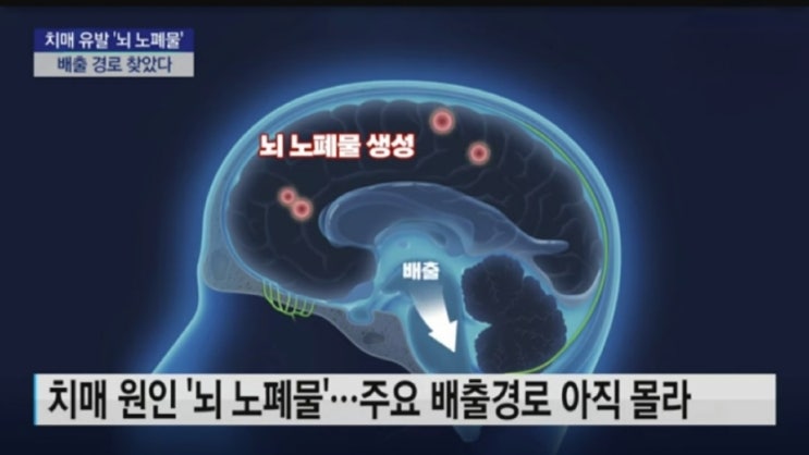 치매 유발 '뇌 노폐물' 배출 경로 찾았다!...치료제 개발 가능성] : 네이버 블로그