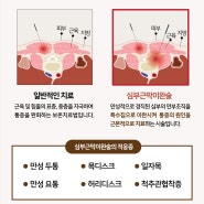 금맥한의원 심부근막이완술