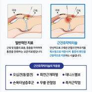 금맥한의원 근건유착박리술