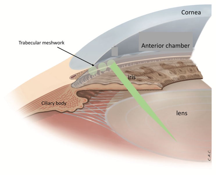 아르곤레이저 섬유주성형술(Argon laser trabeculoplasty, ALT) : 네이버 블로그