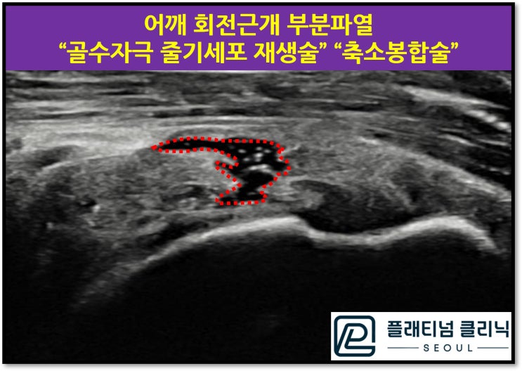 (플래티넘의원)회전근개파열 비수술치료 : 골수자극줄기세포재생술, 축소봉합술