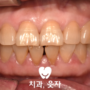 태평역치과 임플란트 고령자를 생각한 비절개식립(옳소플란트)