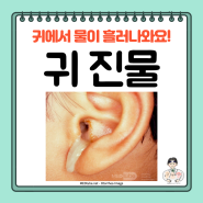 귀 진물 고름(otorrhea), 귀에서 진물, 원인 증상 검사 치료 예방