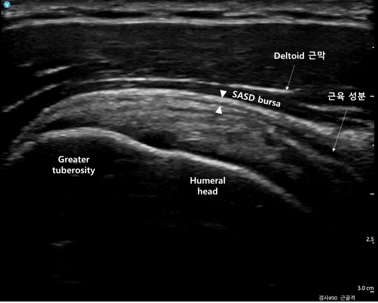 [어깨 초음파] 4. 견봉하 점액낭, 삼각근하 점액낭 (Subacromial-Subdeltoid bursa, SASD bursa ...