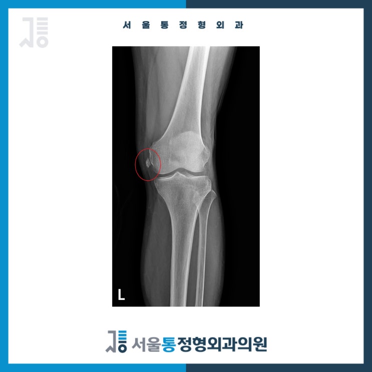 3년 된 석회 덩어리 짜잔하고 없어졌습니다 : 네이버 블로그
