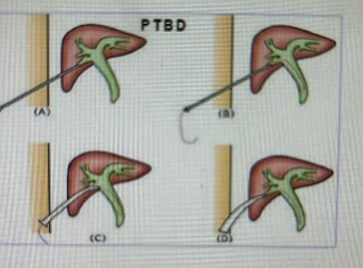 경피경간 담도 배액술, 경피적 담도 배액술(PTBD: percutaneous transhepatic biliary ...