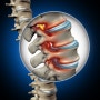 허리통증, 디스크, 척추협착증은 왜 치료가 힘들까?