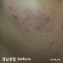리유한의원 강남본점 얼굴 지루피부염 경과 후기