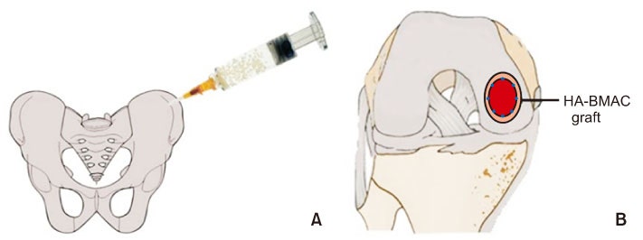 [OS수술] BMAC(Bone Marrow Aspirate Concentrate, 자가골수 줄기세포 치료술) : 네이버 블로그