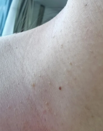 목 쥐젖 원인 제거 후 관리 필수 : 네이버 블로그