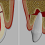 치아파절(치아외상) 원인과 종류, 대처법