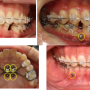 치아 교정 미니 스크류하는 이유와 통증 관리법 제 알아보기(천안 인비절라인)