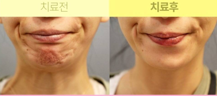 자갈턱 보톡스 효과 부작용 알고 맞으세요. : 네이버 블로그