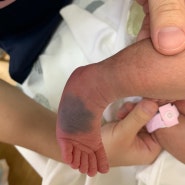 [첫번째 치료] +134일 아기 발등 색소치료 (마포공덕 에스앤유 피부과) 이소성 모반, 오타모반
