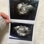 임테기 두 줄 임신 극 초기 4주 아기집 확인 : 내가 엄마라고요.....?