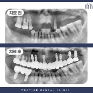 철산동임플란트잘하는곳 치아가 빠진지 오래되었어요!