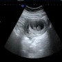 [임신일기] 임신 3개월 9주 4일 젤리곰 초음파 피고임증상