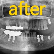 발치 및 임플란트 식립. 오래된 보철물로 인해 치아 통증이 생겼을 때.
