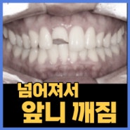 넘어져서 앞니가 부러졌어요(상악전치부 외상) 앞니 파절 지르코니아 크라운 치료 증례