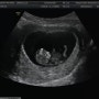 임신 극 초기 4주차~9주차 증상 속쓰림 입덧 및 젤리곰 태아 심장소리