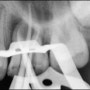 대구치 근관치료 (Endodontic treatment 2 years follow up)