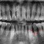 중부동 치과 골이식을 동반한 임플란트 식립 케이스