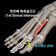 발가락이 꼬여요(발가락 쥐) 원인 및 치료 - 배측 골간근(Dorsal interossei)
