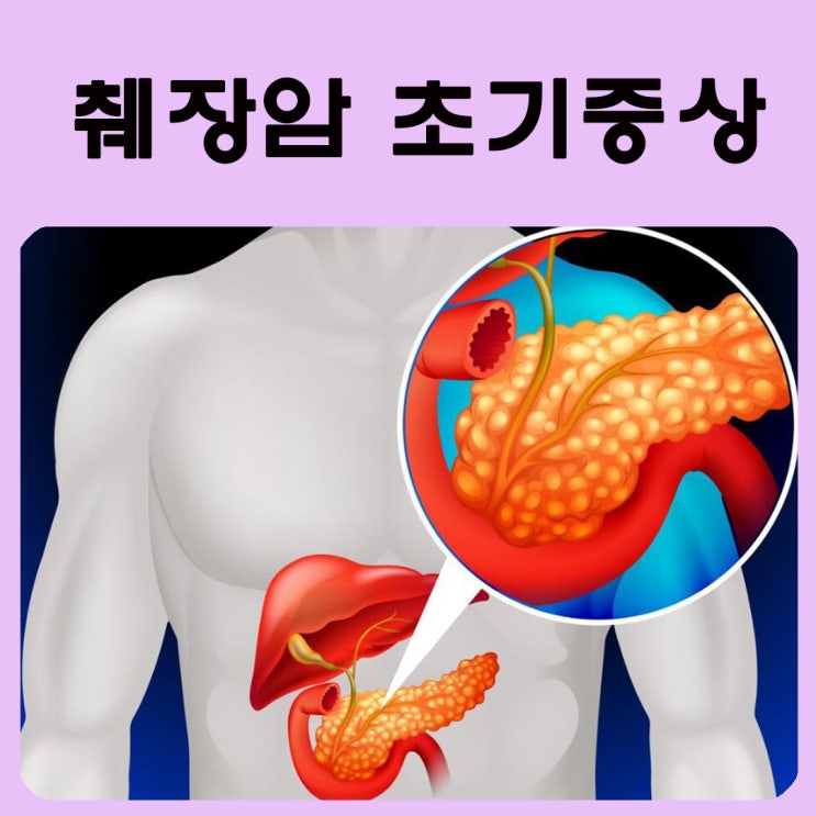 췌장암 초기증상 등통증 위치 주요원인 치료법 예방법 췌장염 : 네이버 블로그
