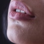 입술물집 헤르페스감염일까? 원인과 치료방법!