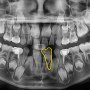"내 치아 모양이 이상하다?" 강동구 치과 에서 알려드리는 치아의 형태 이상의 종류와 치료법