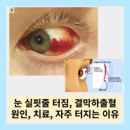 눈실핏줄터짐, 결막하출혈 원인, 통증, 눈 실핏줄 자주 터지는 이유 정리