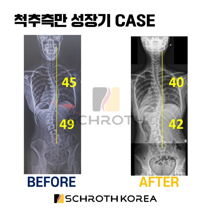 성장기 척추측만 슈로스 운동 수술각도 흉추 45도 요추 49도 흉추 40도 요추 42도 개선 서울 송파 척추측만증 : 네이버 블로그
