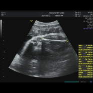 자궁문 1cm 열린 38주 2일차 임신일기(내진, 자궁문, 남아태아크기, 3.5kg, 유도분만)
