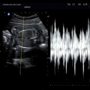 임신 23주차 : 나이키 베이비수트ㅣ태동 사라짐ㅣ눈물의 태동검사, 초음파ㅣ망포동 하얀풍차ㅣ23주 배크기ㅣ영상에 처음 찍힌 태동