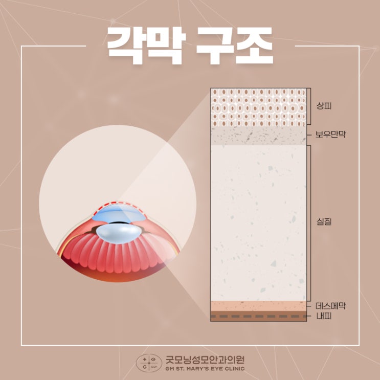 각막 내피세포 감소는 각막 투명도를 떨어뜨려요 : 네이버 블로그