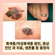 흑색종/악성 흑색종 원인, 증상, 진단 및 치료법, 5년 생존률 등 총정리