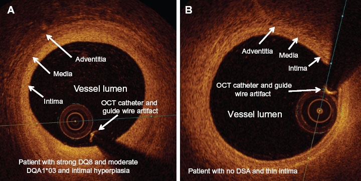 스텐트 시술 결정 보조도구 | 광간섭 단층촬영(OCT,Optical coherence tomography) : 네이버 블로그
