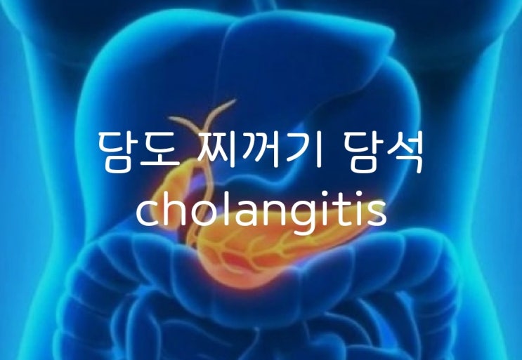 담석과 담도 찌꺼기로 인한 cholangitis 담관염 증상과 검사방법 : 네이버 블로그