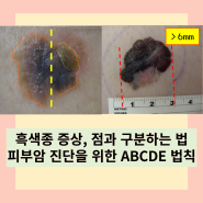 흑색종 알아보기(2)_점과 피부암 구분, 피부암 진단을 위한 ABCDE법칙, 진단 정리